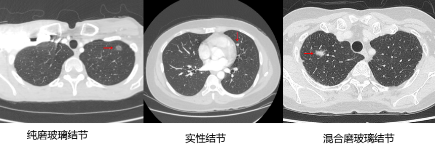 【高新轉(zhuǎn)載】肺結(jié)節(jié)與肺癌有的區(qū)別在哪呢？