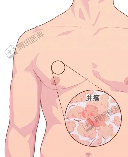 男人很容易忽視的一種癌，確診大多是晚期