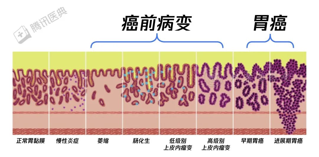 胃癌來(lái)臨前，會(huì)經(jīng)歷這個(gè)階段！千萬(wàn)別不當(dāng)回事